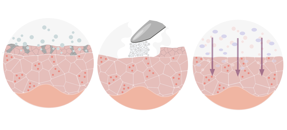 Microdermabraserie - alle stappen_SkinTense